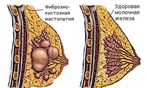 Mastopatía fibroquística de las glándulas mamarias: ¿es necesario tratar la enfermedad?