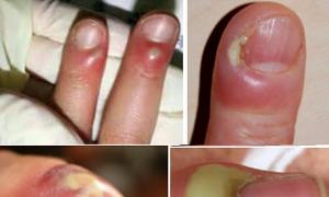 Zdravljenje prstov Panaritium doma