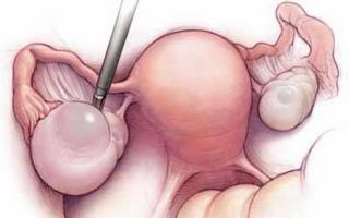 डिम्बग्रंथि पुटी के साथ गर्भवती कैसे हों: क्या गर्भधारण संभव है और महिलाओं की समीक्षा