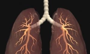 Ali so kakšne koristi od ljudskih zdravil pri zdravljenju pljučne sarkoidoze?