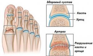 Stop artroza: zdravilo za bolezni sklepov