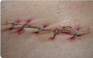 No cura la sutura después de la cirugía.
